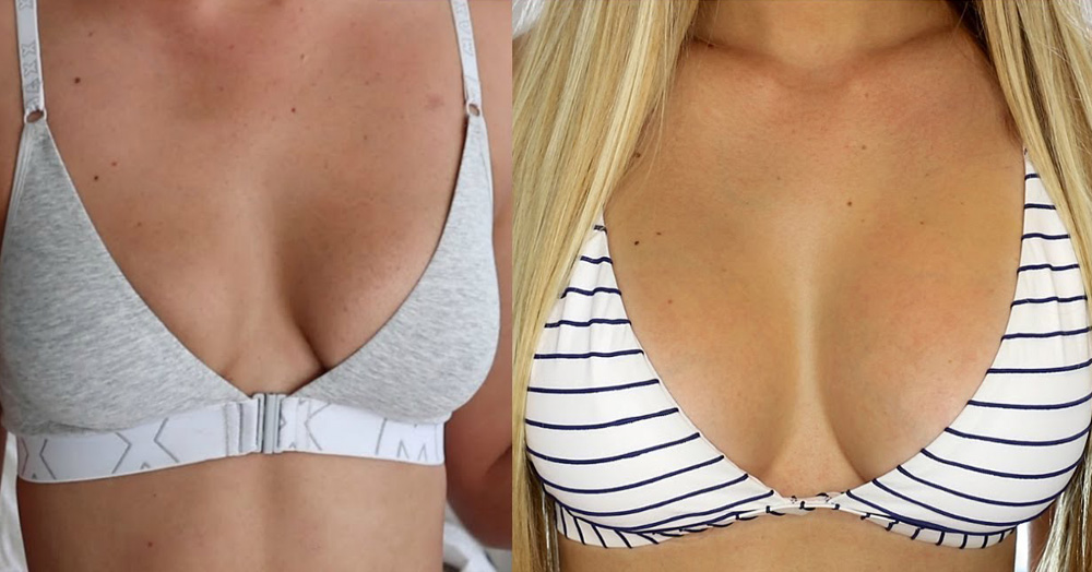 Breast Implants in tijuana