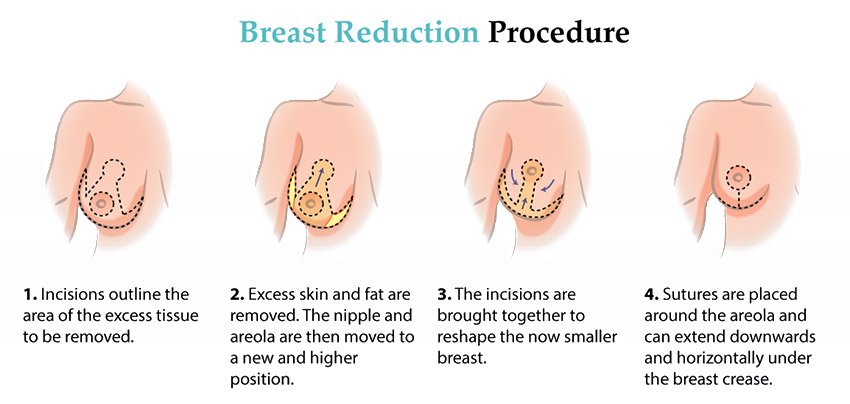 Breast Reduction in tijuana